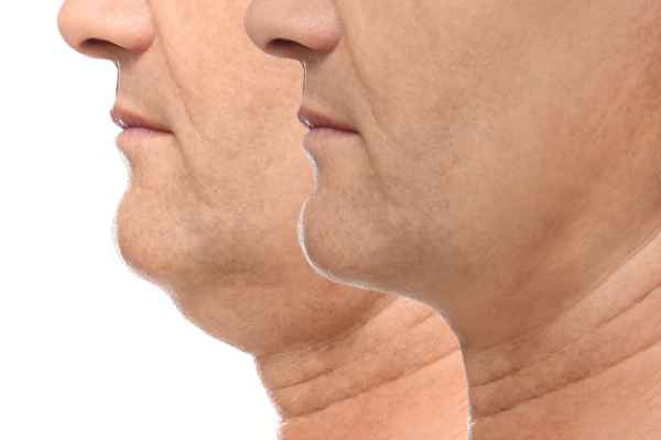 HIFU - Breakthrough in Anti - ageing 2 hifu results Llanelli