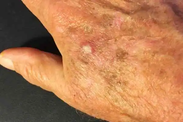 Image of Actinic keratoses Llanelli on a person hand