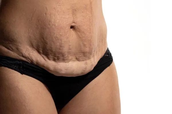 The science behind skin tightening Llanelli picture of a woman's sagging skin on the stomach